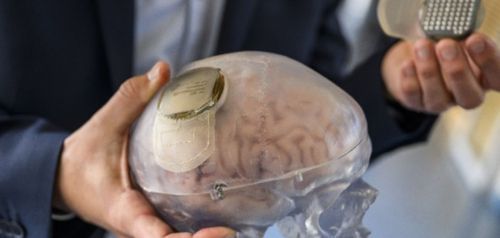 O Έλον Μασκ πήρε άδεια για να εμφυτεύσει εγκεφαλικά τσιπ σε ανθρώπους