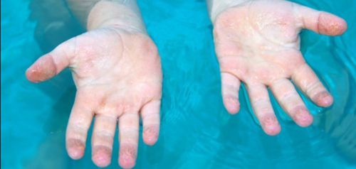 Γιατί ζαρώνουν τα δάχτυλα όταν μένουν πολλή ώρα στο νερό